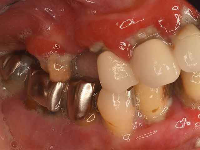 歯茎が腫れてきて進行している気がする