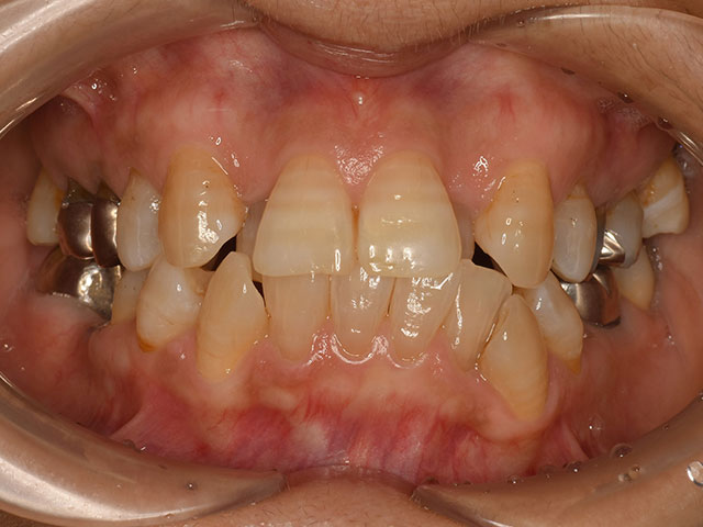 加齢とともに歯並びが悪くなってきたように思う