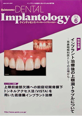 2013年　インプラントロジー　9月号Maxillary Sinus Augumentation at Loma Linda 