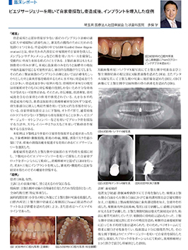 2019年　株式会社インプラテックス　臨床レポートピエゾサージェリーを用いて自家骨採取し骨造成後インプラントを埋入した症例
