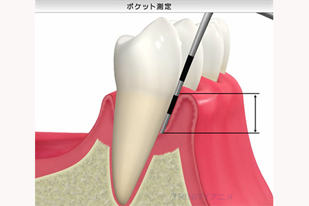 5．歯周病の検査