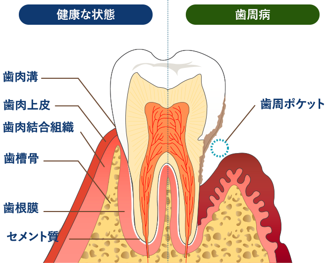歯周病菌の増殖で歯周ポケットができてどんどん深くなっていきます