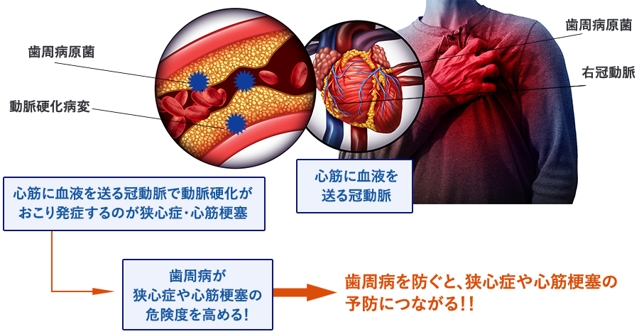 歯周病を防ぐと、狭心症や心筋梗塞の予防につながる！！