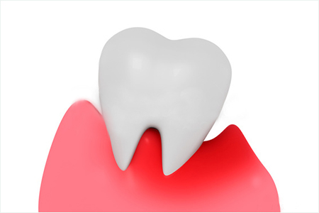 手遅れになることもある歯周病