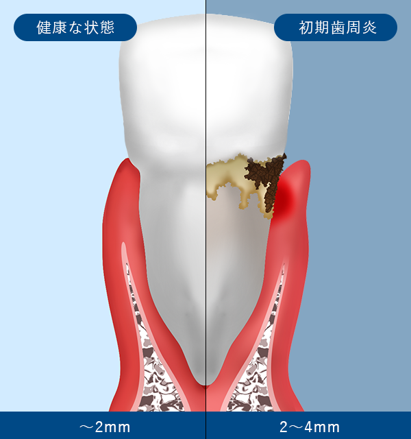 歯肉炎