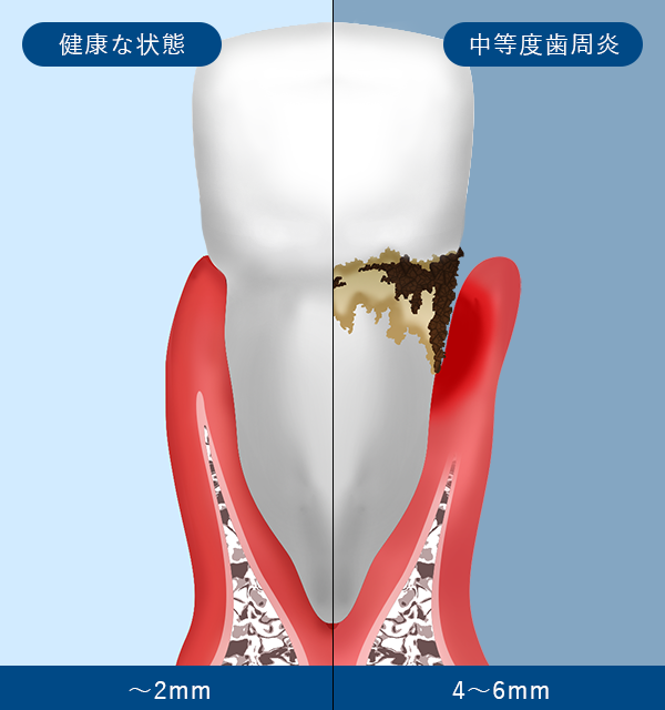 歯肉炎