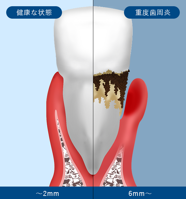 初期歯周炎