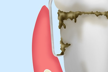 ルートプレーニング（歯肉縁上の歯石除去）