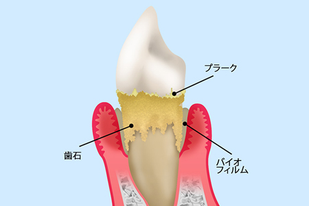 歯肉縁上の歯石と歯肉縁下の歯石