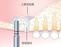 STEP02 上顎洞粘膜の挙上と骨補填材の注入