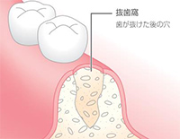 STEP01 抜歯