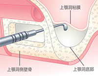STEP01 上顎洞側壁骨の除去と上顎洞粘膜の挙上