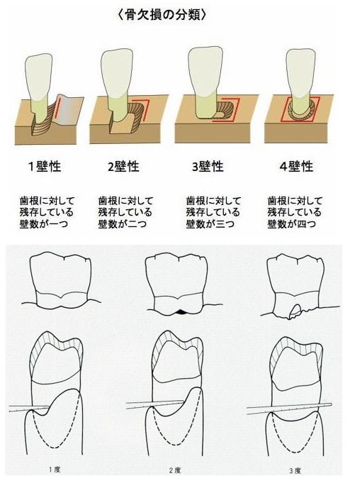 歯肉炎・歯周炎の分類